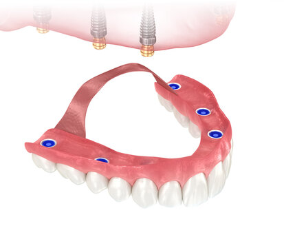 Removable prosthesis based on six implants. Dental 3D illustration