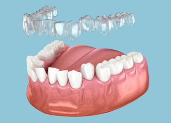 Invisible retainer make bite correction. Medically accurate 3D animation
