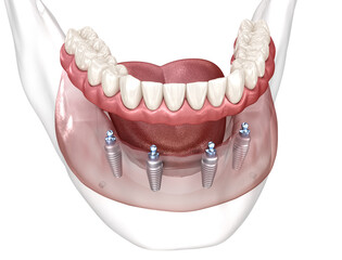 Dental prosthesis based on 4 implants. Dental 3D illustration