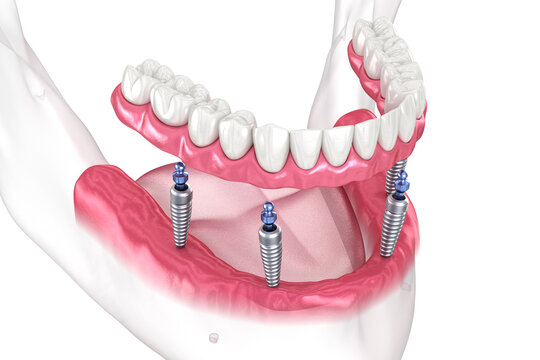 Dental prosthesis based on 4 implants. Dental 3D illustration