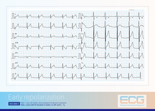 Early repolarization is a common benign ECG change that manifests as J-point ECG with or without ST-segment elevation.
