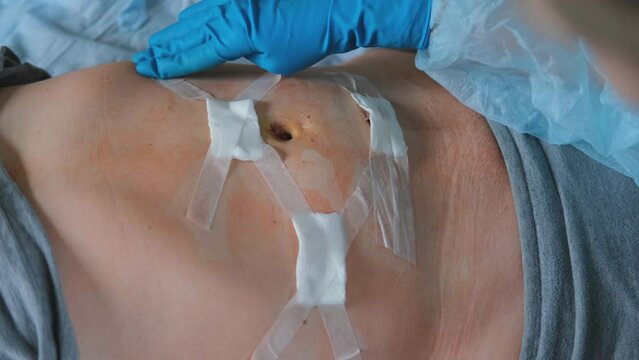 Hands of medic or nurse in blue gloves examining a fresh suture on a male stomach after laparoscopy surgical removal of appendicitis. Doctor examines of the patient. Man belly with medical stitches