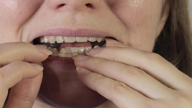 Medical treatment footage of a Woman puts Soft mouth guard for TMJ, TMD in her mouth. Teeth protection. Dental guard. TMJ disorder. Pain in jaw. Teeth grinding.
