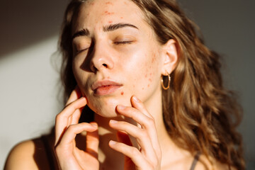 Acne on woman's face with rash skin ,scar and spot that allergic to cosmetics. Medicine and cosmetology concept. Natural skin.