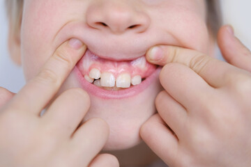 Young Smiling child, boy, age 10 reveals growing teeth, marking milestone in dental development,...