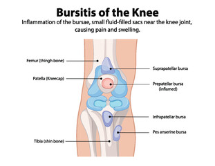 Fototapeta premium Inflammation of knee bursae causing pain and swelling