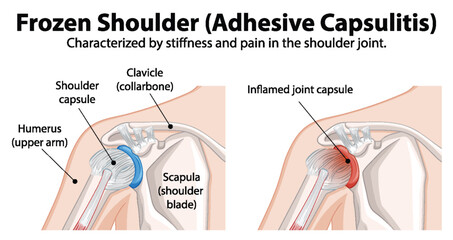 Diagram explaining adhesive capsulitis in shoulder joint