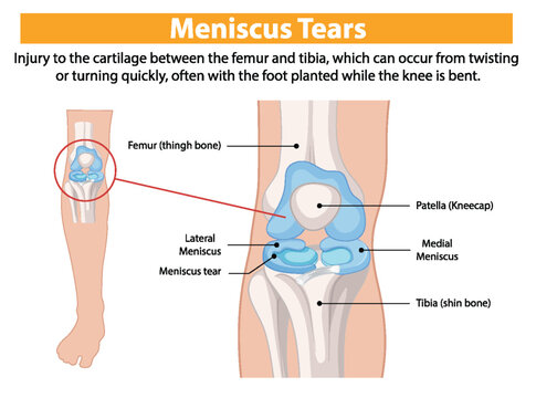Illustration of knee meniscus tear and anatomy
