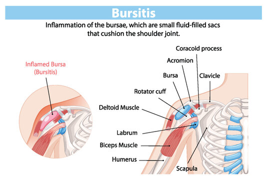 Detailed anatomy of shoulder bursitis inflammation