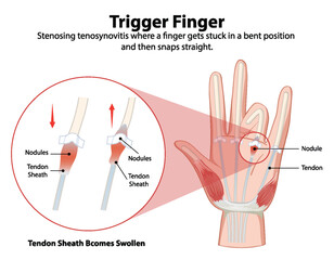 Detailed depiction of trigger finger condition