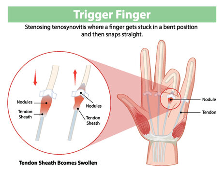 Diagram explaining trigger finger condition
