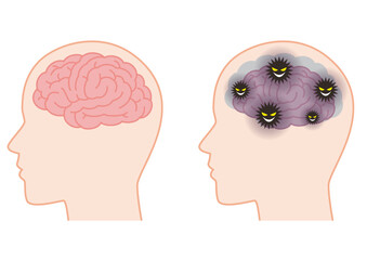 健康な脳とゴミが溜まって萎縮した脳