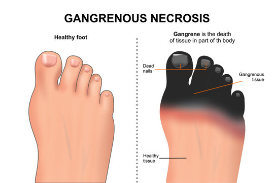 Gangrenous Necrosis Illustration on Foot