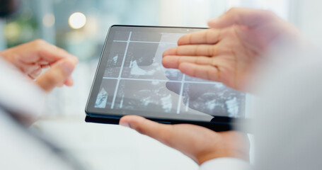Doctor, hands and x ray with tablet screen for discussion on medical results, exam or test at...