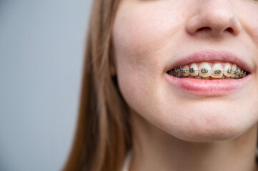 Unrecognizable red-haired girl with braces smiles. Young woman corrects bite with orthodontic...