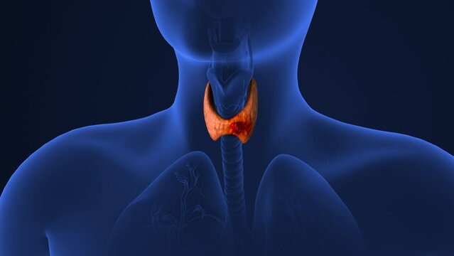 Tumor spread in the thyroid gland.