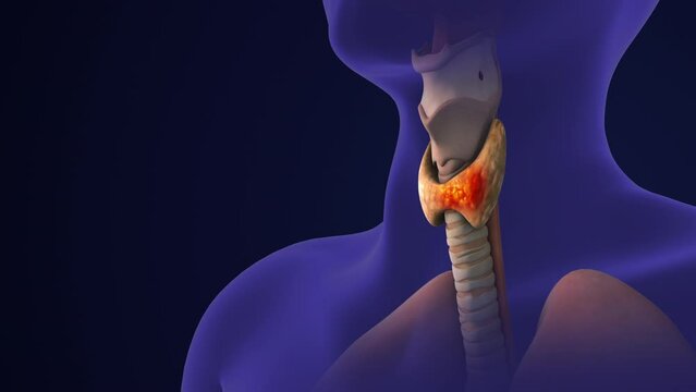  Medical animation of Thyroid gland cancer.