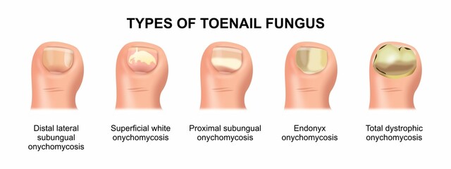 Fungal nail infection toenail illustration