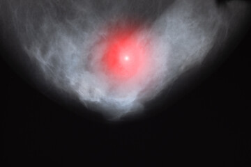 X-ray scan of woman's breast. Medical treatment concept. Diagnosis of the disease breast cancer.