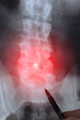 Doctor examining X-ray and MRI, MRT, CT with the human spine with defects in bones and vertebrae....