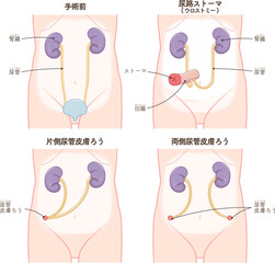 尿路ストーマ、ストーマ、ウロストミー、urostomy、オストメイト、大腸、小腸、膀胱、イラスト、illustration