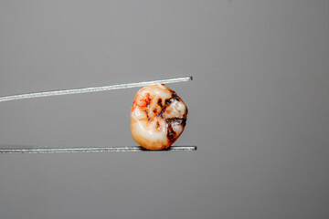 Wisdom teeth cause problems in the mouth.