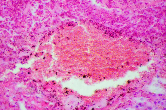 Micrograph of lobar pneumonia red hepatization stage