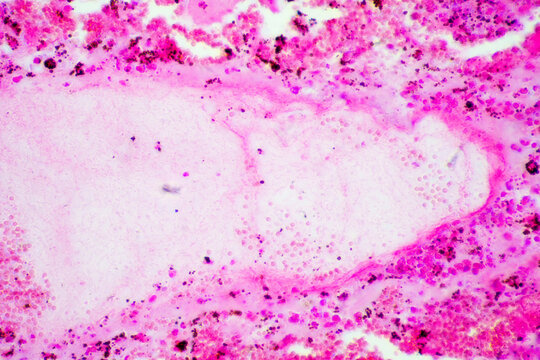 Micrograph of lobar pneumonia red hepatization stage