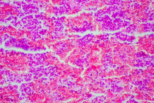Micrograph of lobar pneumonia red hepatization stage