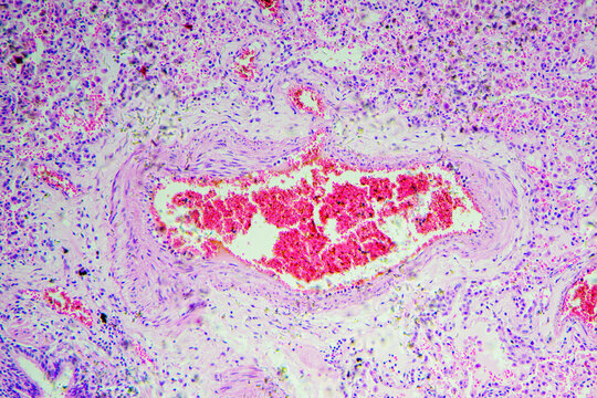 Micrograph of lobar pneumonia dissolution phase recovery stage