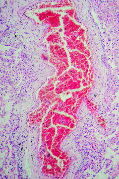 Micrograph of lobar pneumonia dissolution phase recovery stage