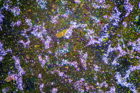 Micrograph of lobar pneumonia dissolution phase recovery stage