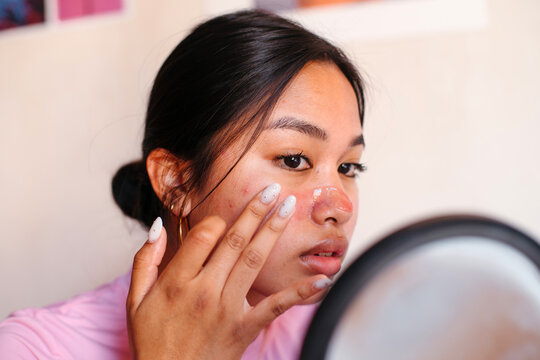 Asian teen with pimples applying face mask