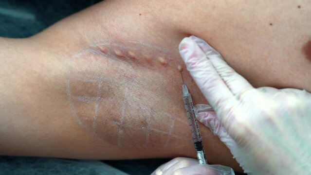 A doctor injects Botox into a patient's armpit to reduce sweating. The concept of beauty and modern technologies.