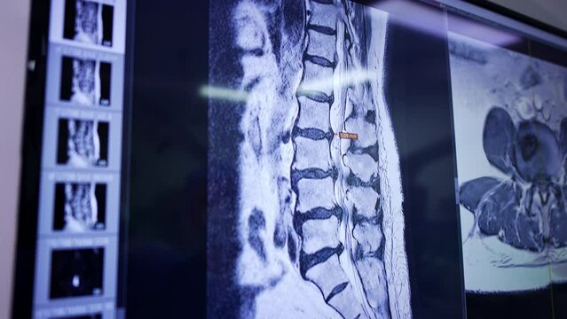 Checking the spine of a patient at the MRI scan. Large screen shows the scans during the neurosurgery.