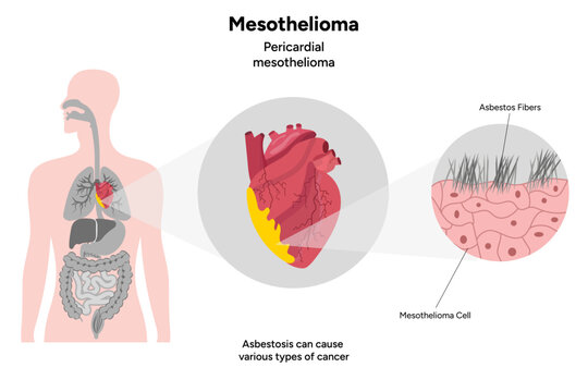Mesothelioma, Pericardial mesothelioma zoom