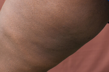 Dark inner thigh on brown skin, hyperpigmentation and darkening of inner thigh on brown skin