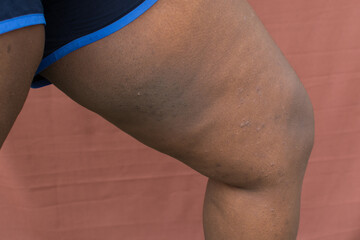 Eczema on brown skin, atopic dermatitis and prurigo nodularis on brown skin leg, eczema breakout on dark skin