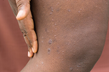 Eczema on brown skin, atopic dermatitis and prurigo nodularis on brown skin leg, eczema breakout on dark skin