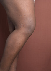 Eczema on brown skin leg, brown skin with hyperpigmentation and scarring from eczema and atopic...