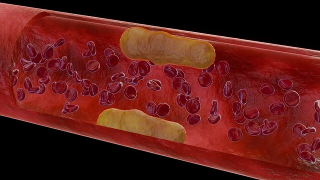 3d Blood cells with cholesterol plaque
