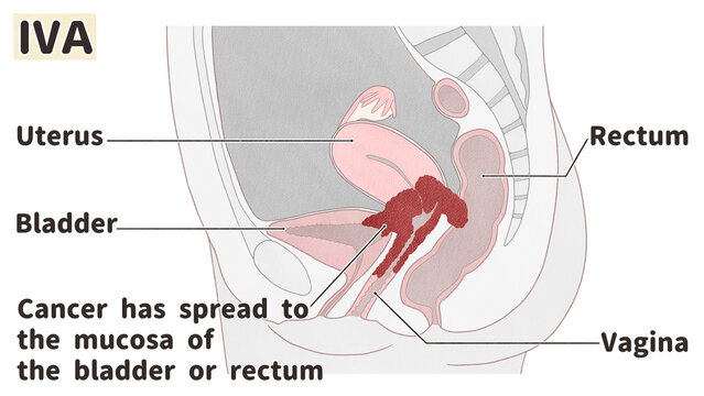 Cervical cancer stage 4A diagram PNG