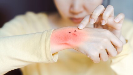 Obraz premium Close-up of a person's hand with a red, irritated skin reaction, possibly a rash or insect bite, highlighting skin care and medical attention.