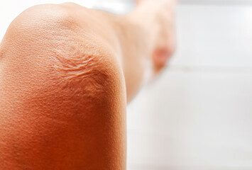 Close-up of scars on knee skin imperfections or defects caused by an accident scar healthcare concept
