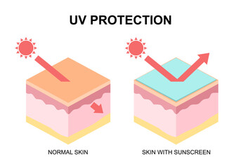 Protection UV ray of skin with uv filter and without. Illustration about sunblock cream uv protection.