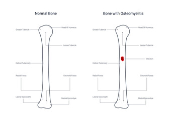 Diagram of bone with osteomyelitis disease in line style