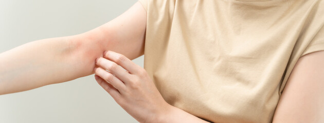 young woman scratching on her arm and has a red rash irritation on her skin from dust intolerance.