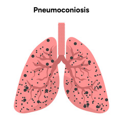 Pneumoconiosis, dust in alveoli 