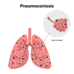 Pneumoconiosis, dust in alveoli 