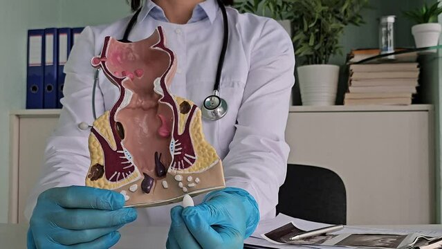 Doctor Explains Hemorrhoid Treatment With Model and Pill